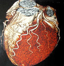 64列CT撮影画像（心臓）